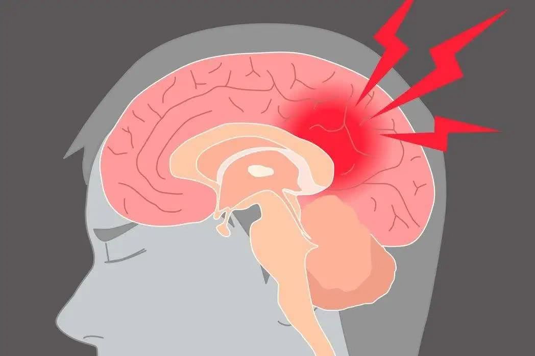 預防腦梗從習慣做起,這三大壞習慣,有的趕緊改正! 預防腦梗從習慣做起,這三大壞習慣,有的趕緊改正!